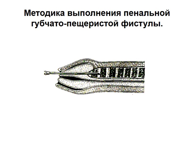 Методика выполнения пенальной губчато-пещеристой фистулы.